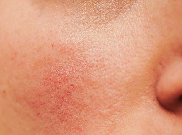 Calm and Comfort "Rosacea and Couperose”