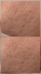 Foto prima e dopo di un trattamento per cicatrici post-acne da Skin Symphony a Milano. Il 'prima' mostra una pelle irregolare con infiammazione silente. Il 'dopo' rivela una barriera cutanea sfiammata e riparata, preparata correttamente per il microneedling estetico in sicurezza.