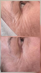 Risultati prima e dopo sulle rughe profonde del contorno occhi. Skin Symphony Milano dimostra come la decontrattura muscolare manuale specializzata distenda le linee d'espressione, resettando la memoria strutturale del tessuto prima di una seduta di microneedling a 0.5mm.