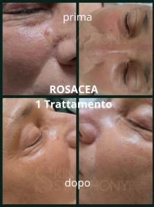 trattamento viso rosacea couperose pelle sensibile risultati foto prima-dopo